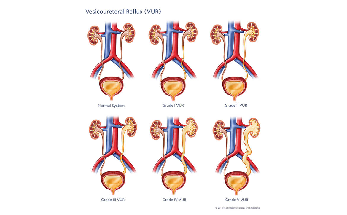 Traitement du reflux vésico-urétéral, Chirurgie du reflux vésico-urétéral 